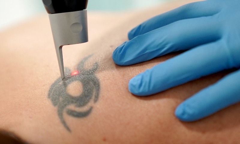 Eliminación de Tatuajes