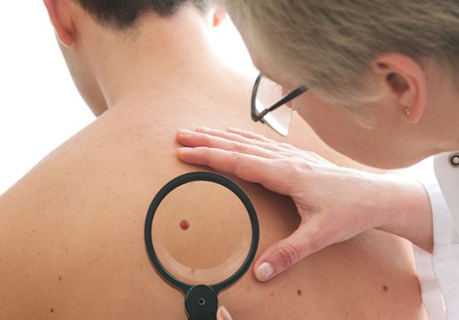 eliminacion-de-lunares