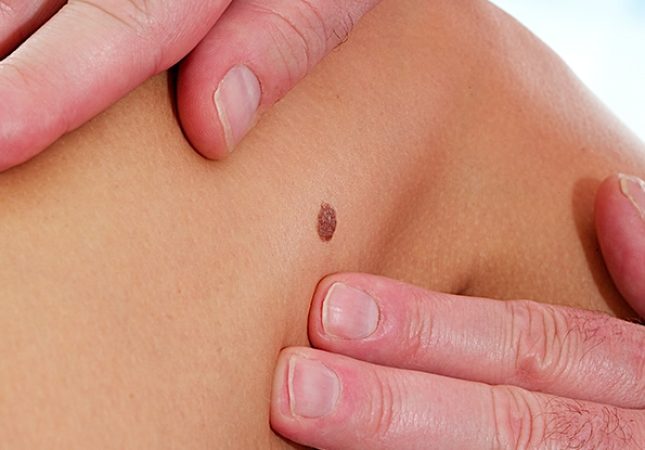 eliminar_lunares_didac_barco