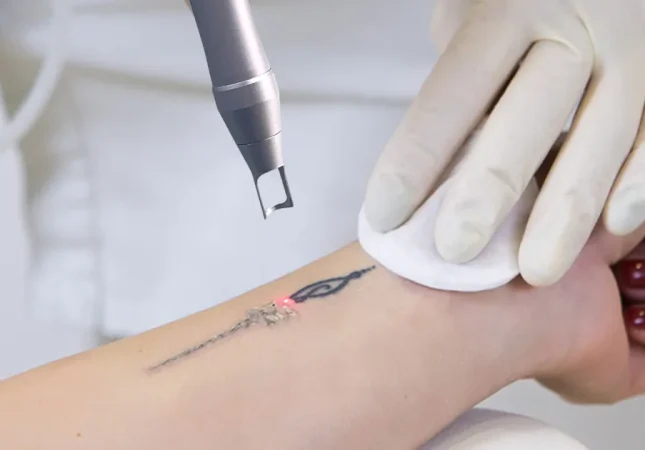 pico-laser-tattoo-removal.jpg